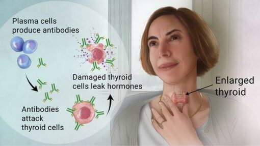 autoimmune thyroid Axe Holistic Medicine Functional